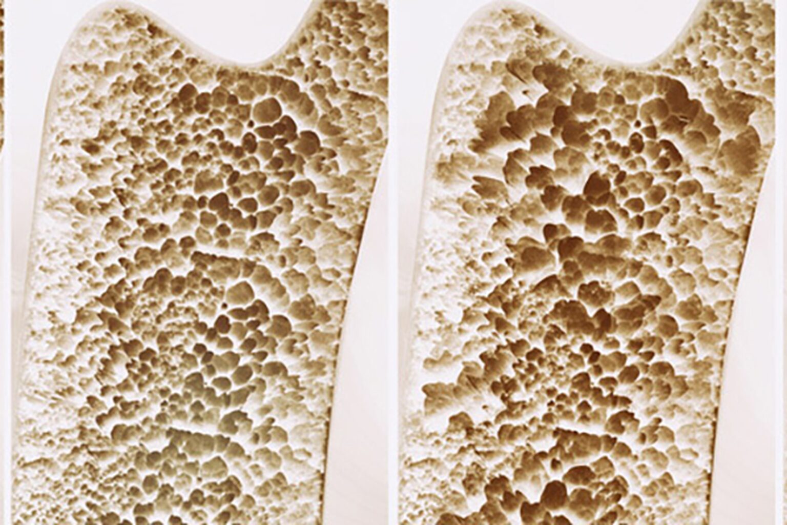Hueso sano frente a hueso con osteoporosis