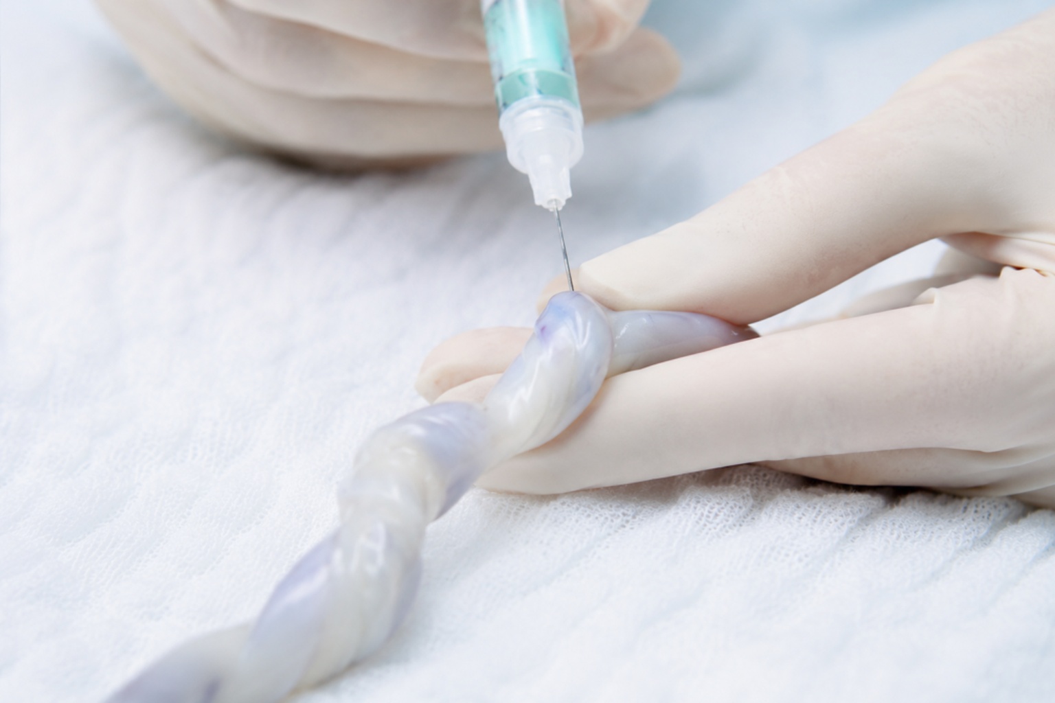 Recogida de sangre del cordón umbilical con material estéril