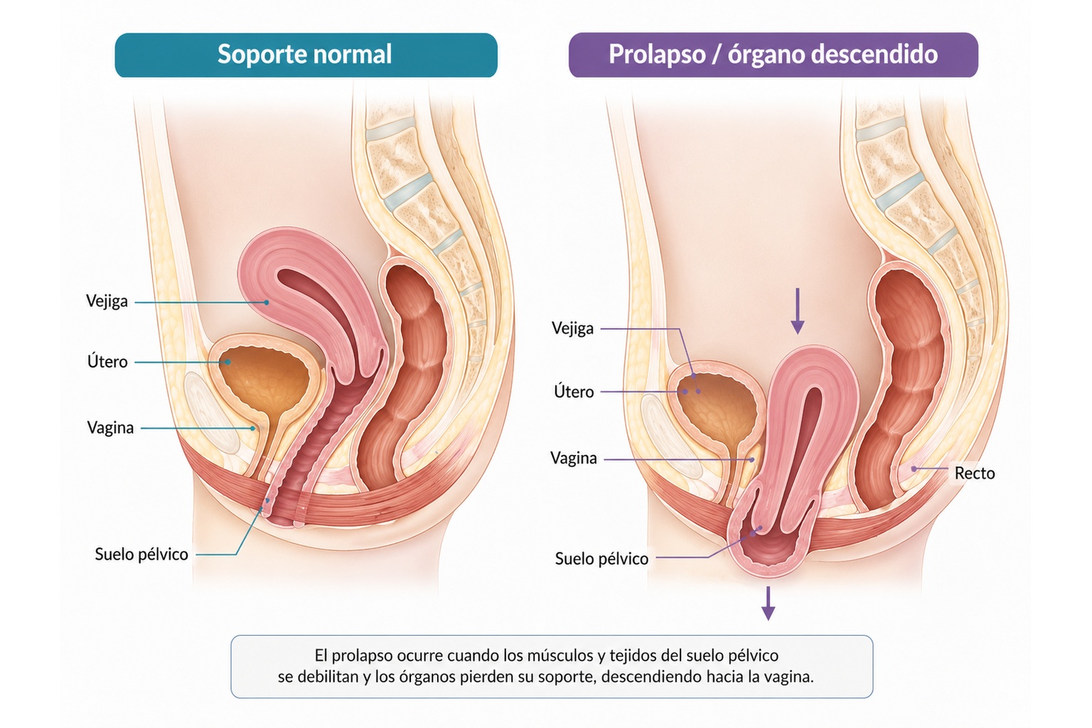 Soporte normal de los órganos pélvicos y prolapso